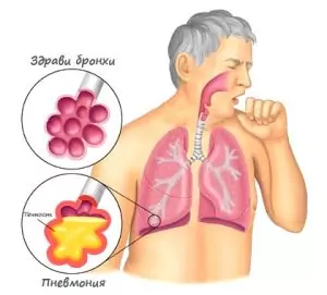 Бронхопневмония