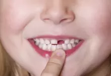 Падане на зъби