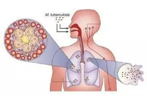 Туберкулоза