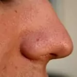 Черни точки по кожата