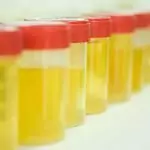 Албумин в урината