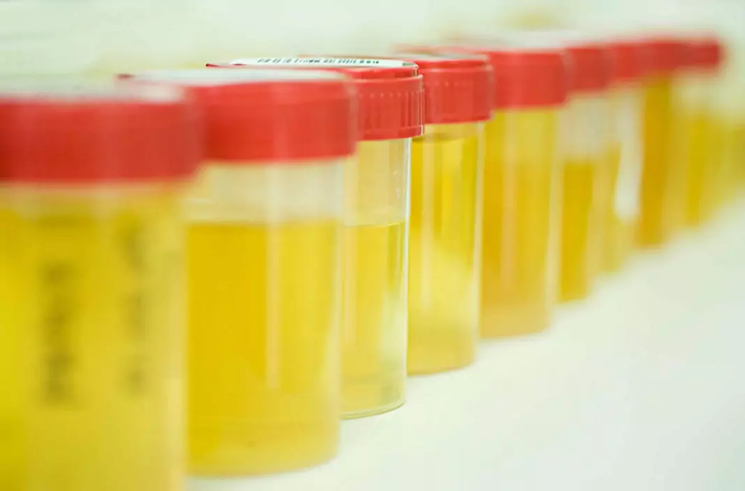 Албумин в урината