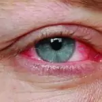 Конюнктивит