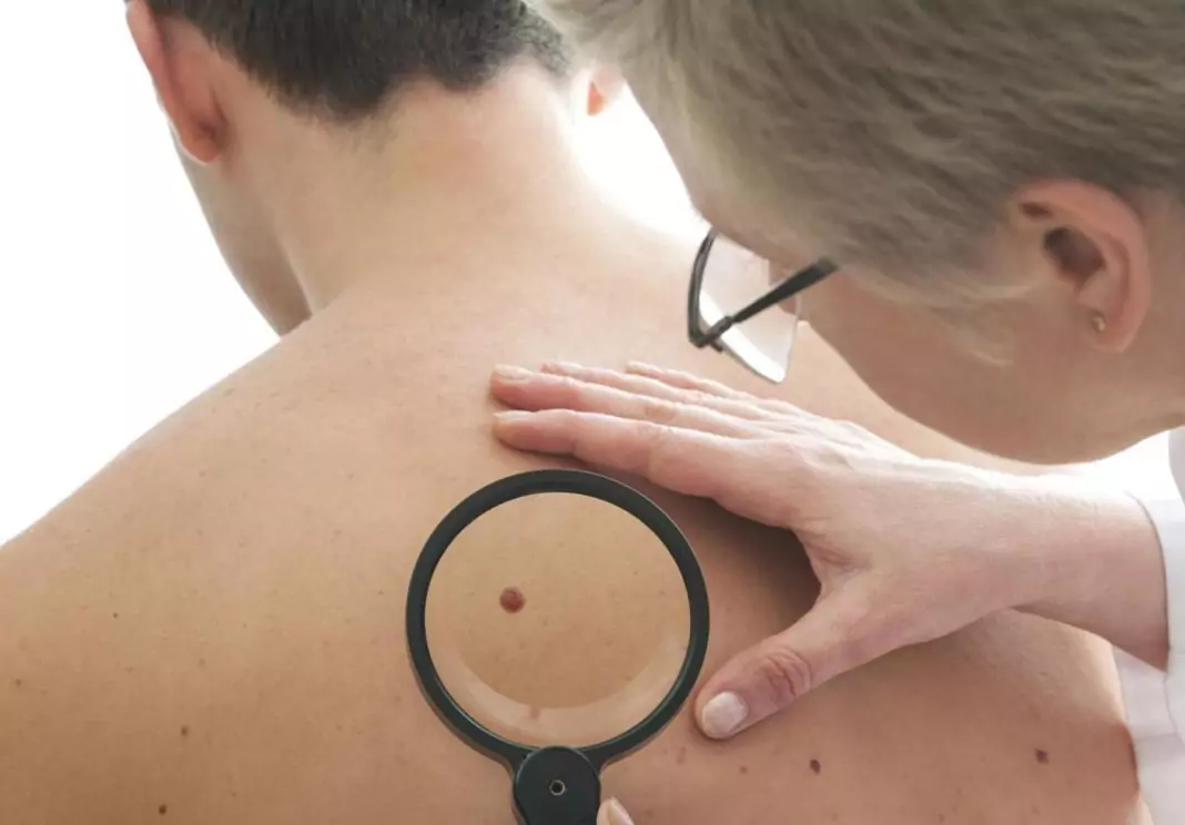 Струпеи по кожата