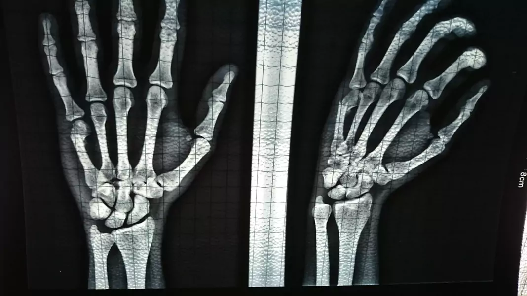 Пукнати и счупени кости