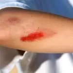 Ожулено и одраскано