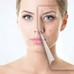 Разширени пори на лицето