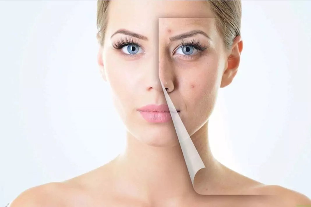 Разширени пори на лицето