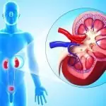 Пиелонефрит