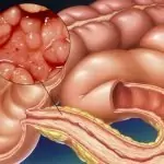 Полипи на задното черво