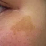 Пигментни петна