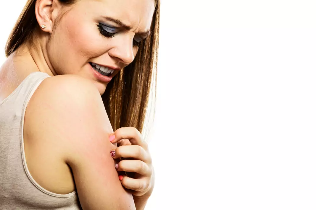 Екземата напада през лятото