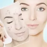 Излекувай акнето