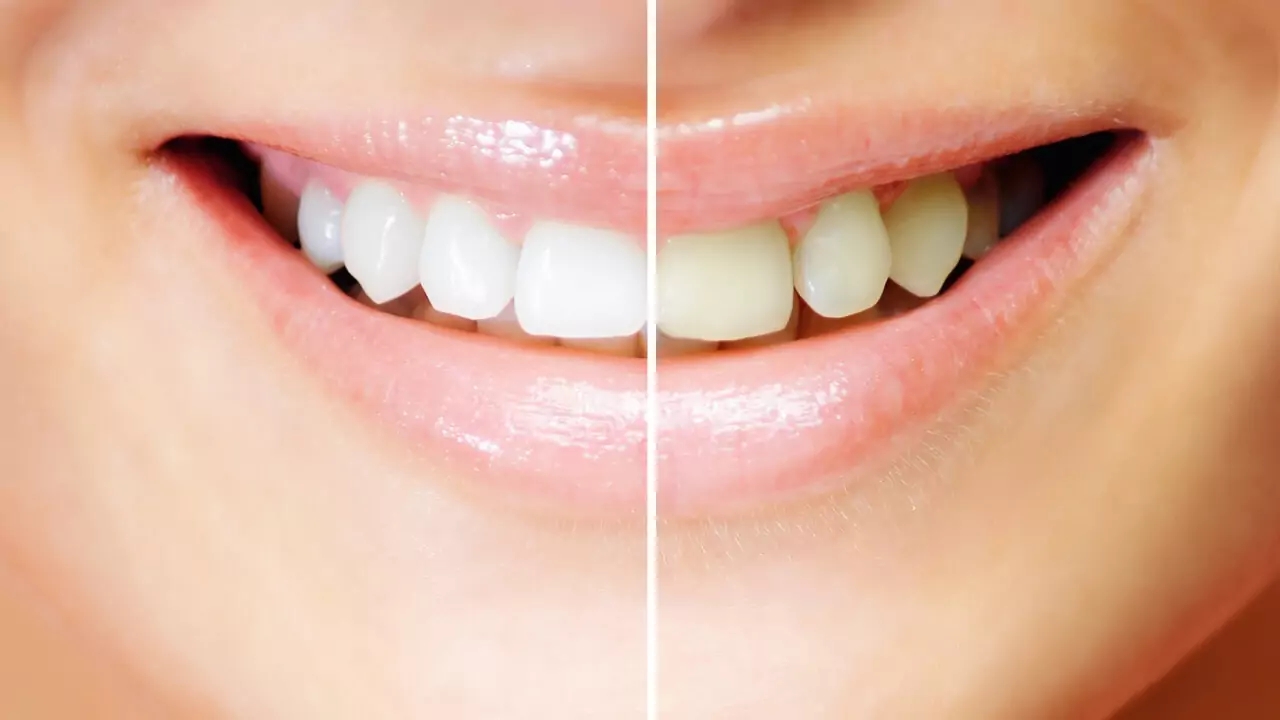 зъбната плака