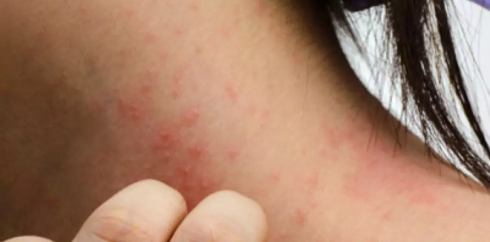 Екзема на кожата Екзема на кожата