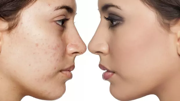 Премахнете акнето Премахнете акнето