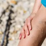 Настойка от бяла акация помага при разширени вени