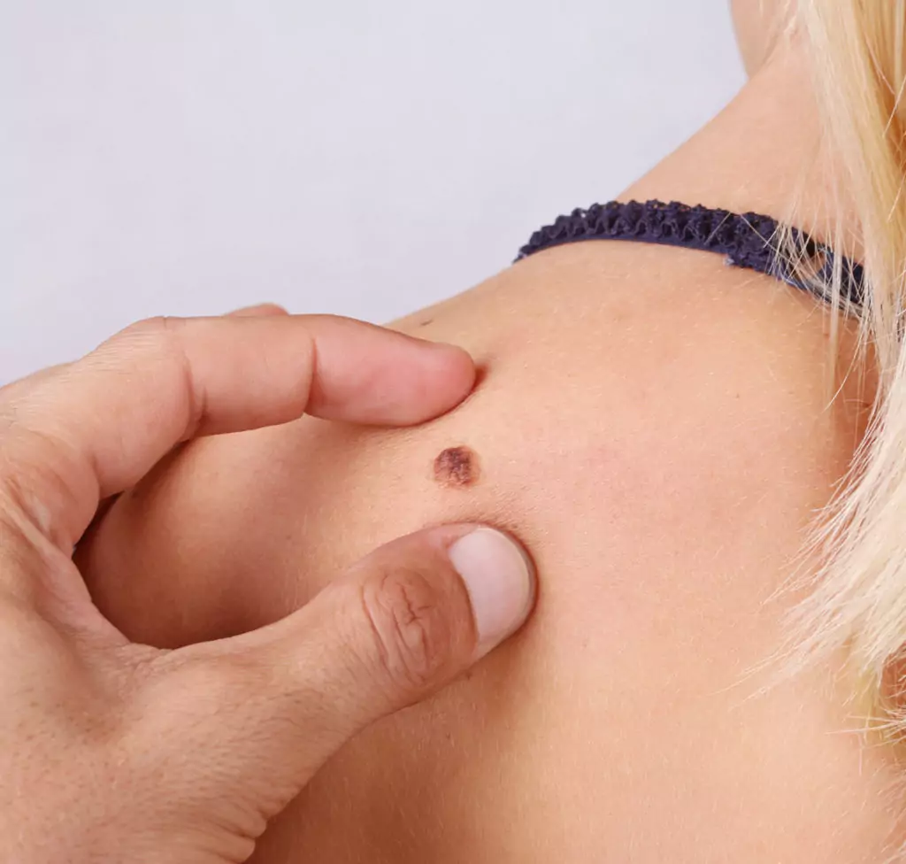 Сок от смокиня маха брадавиците