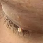 Сок от смокиня маха брадавиците