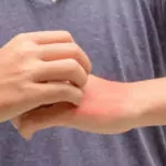 Атопичен дерматит