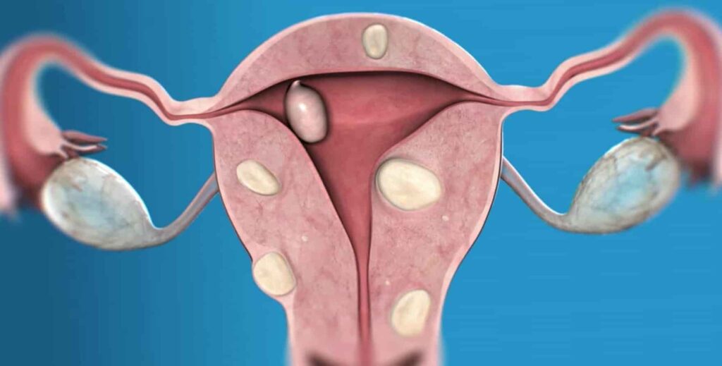 Миома на матката - симптоми и лечение