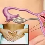 Миома на матката – симптоми и лечение