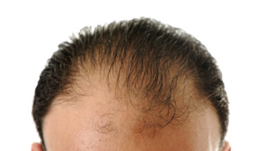 hair loss